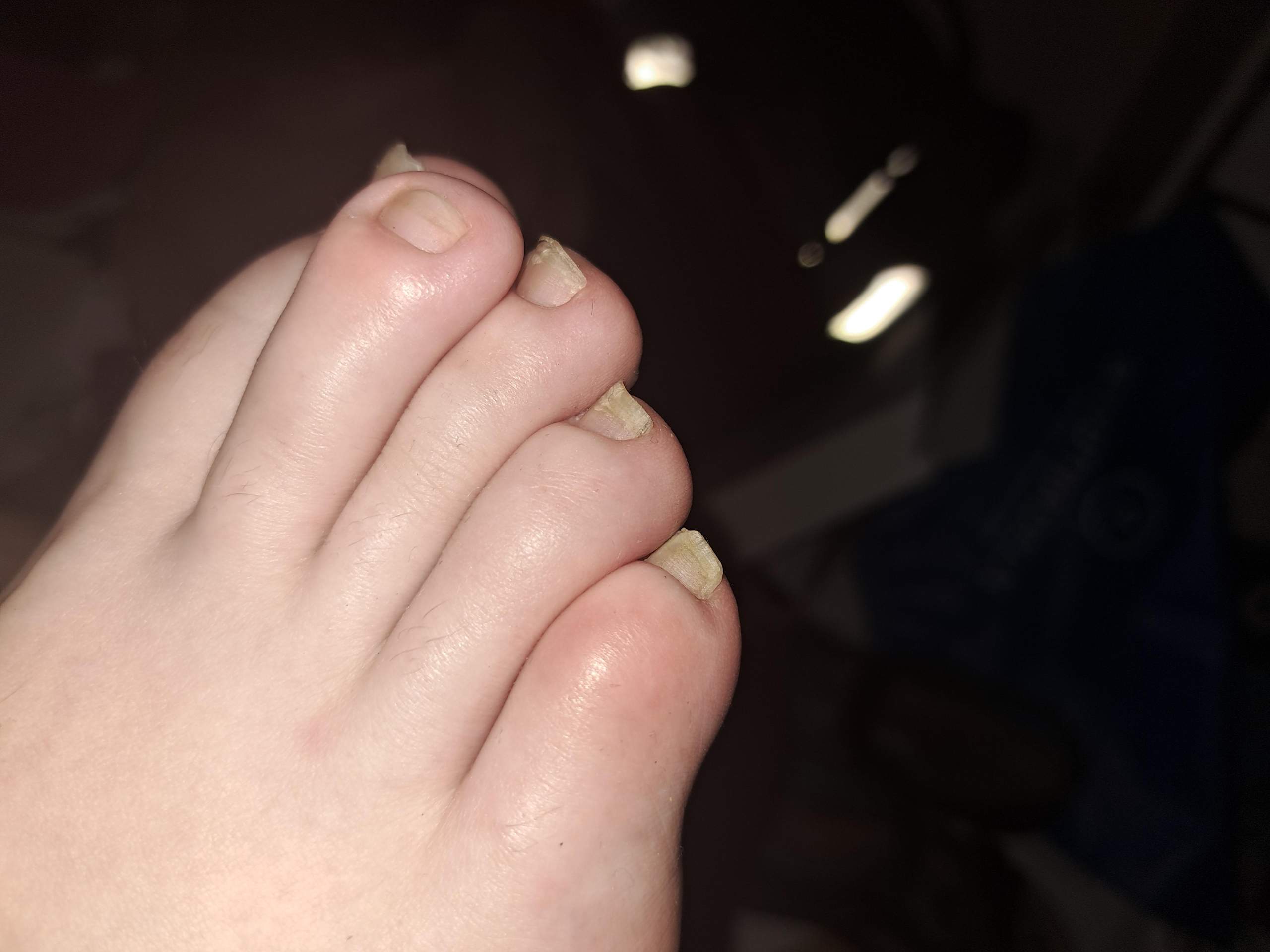 Brüchige Fußnägel. Wie wachsen Sie besser und brechen nicht mehr