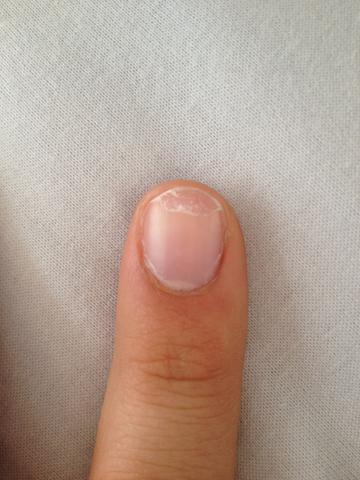 Bruchige Und Splitternde Nagel Hilfe Kaputt Nagellack Bruchig Bruchige Und Splitternde Nagel Hilfe Kaputt Nagellack Bruchig