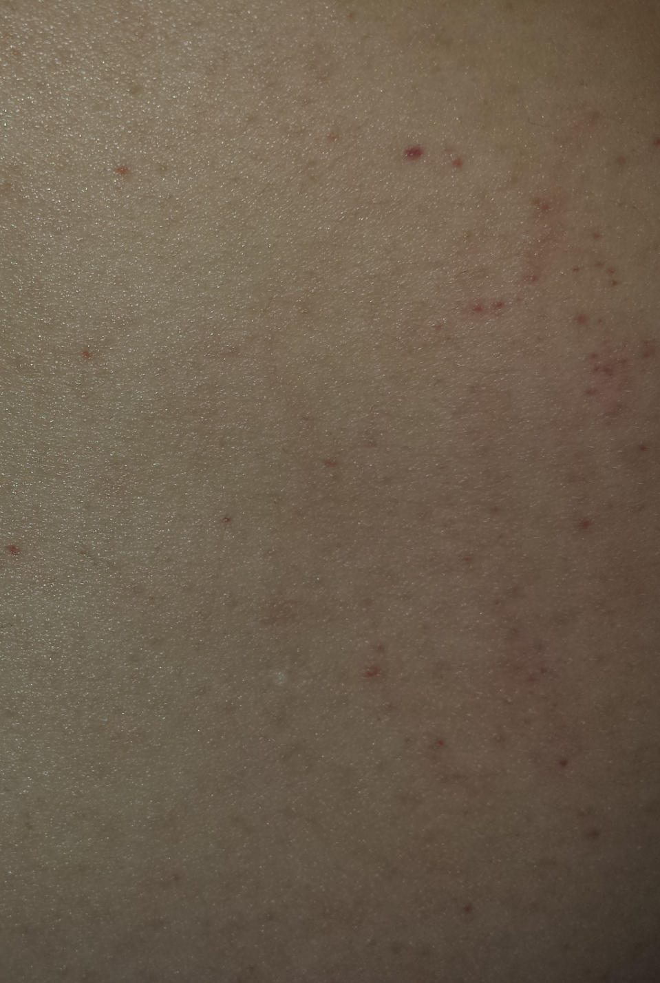 Brust und Bauch lauter rote Punkte (Haut)