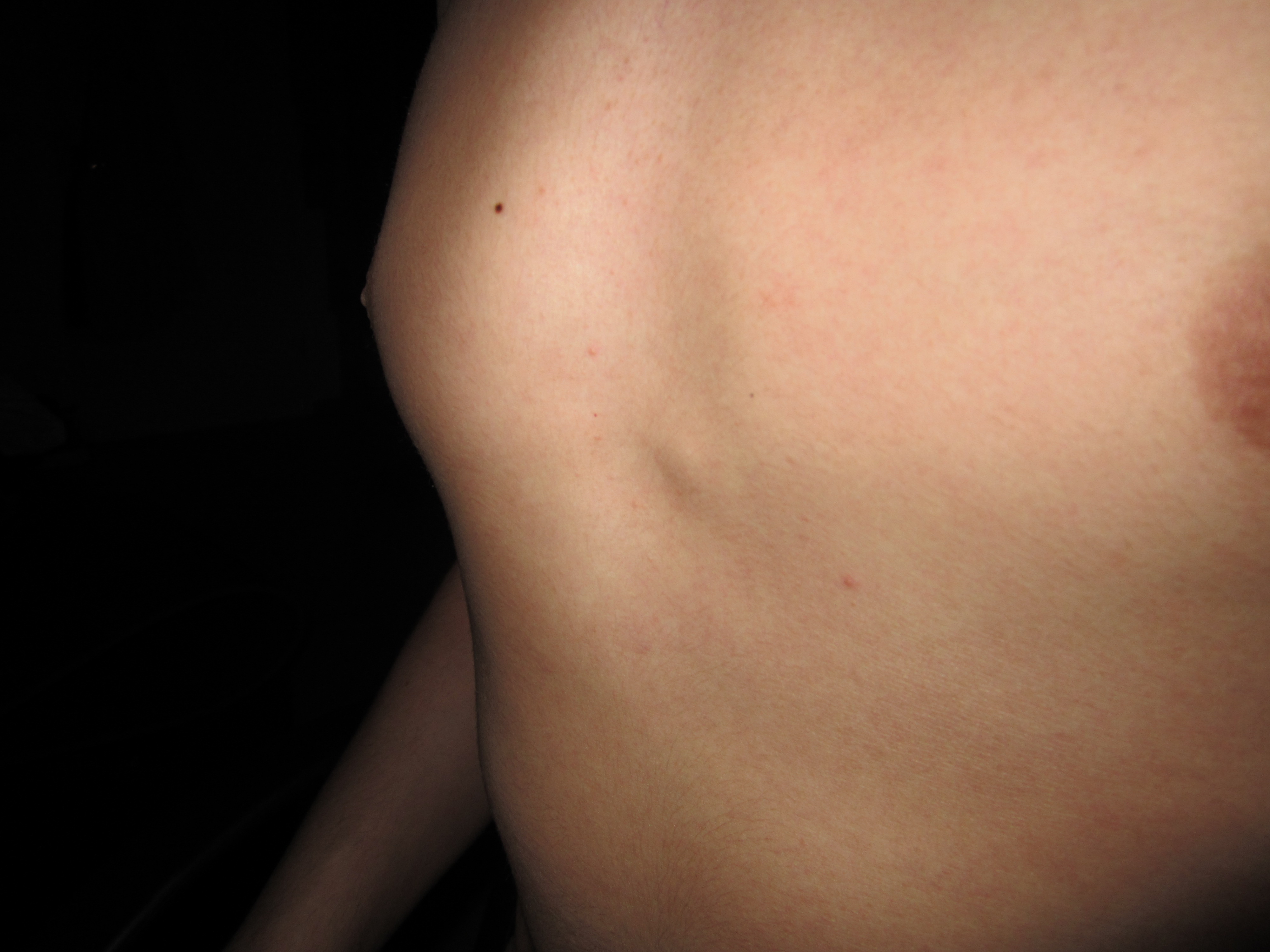 Brustkorb verformung (Knochen)