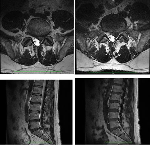 MRI - (Bandscheibenvorfall, Bandscheibe, LWS)