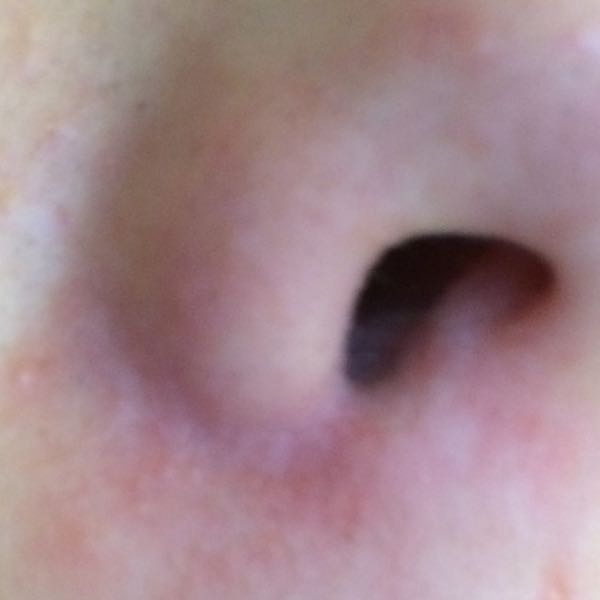 Chronische Rötung unter der Nase? (Medizin, Krankheit, Kosmetik)