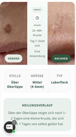 Creamole Creme hilfreich? (Haut, Flecken, Muttermal)