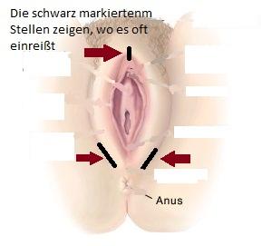 Demonstration - (Intimbereich, trocken)