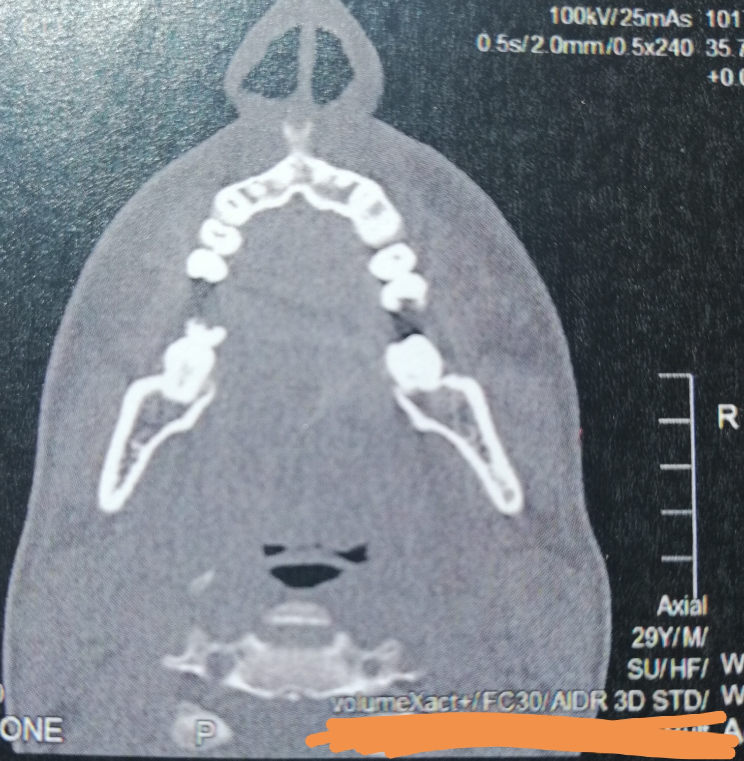 CT der Nasennebenhöhlen /Nase, alles ok? (kernspintomographie)