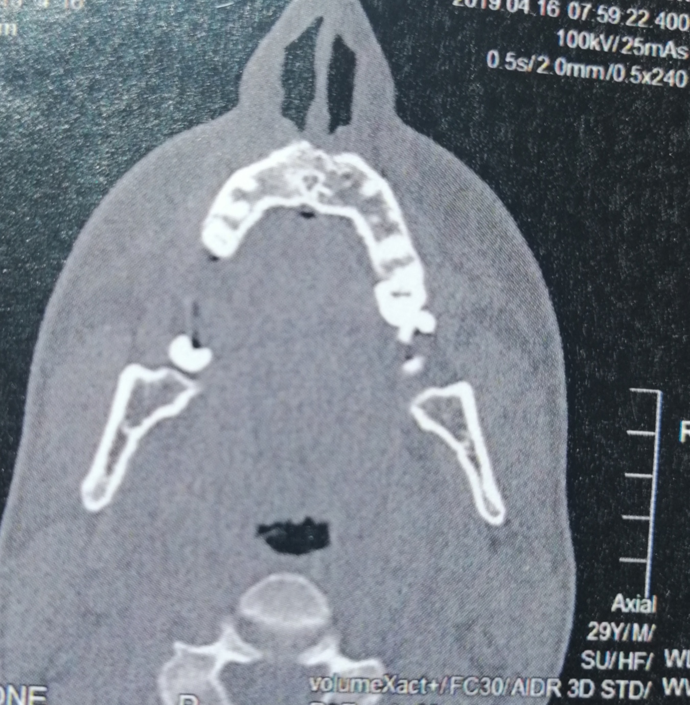 CT der Nasennebenhöhlen /Nase, alles ok? (kernspintomographie)