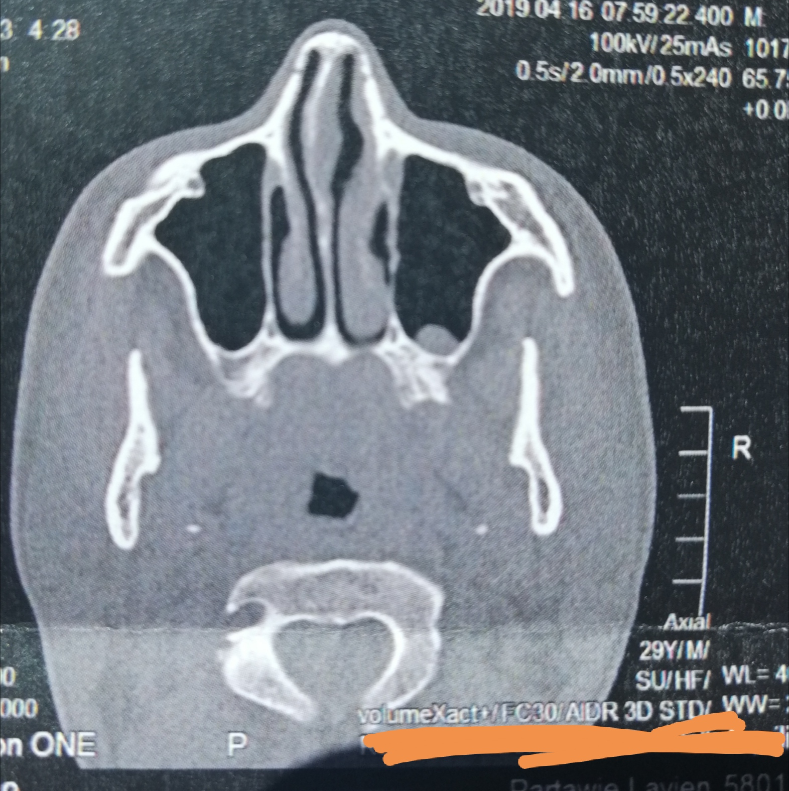 CT der Nasennebenhöhlen /Nase, alles ok? (kernspintomographie)