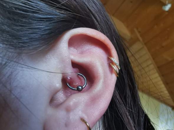 Daith Piercing entzündet, rote große Knubbel an Einstichstellen. Was ...