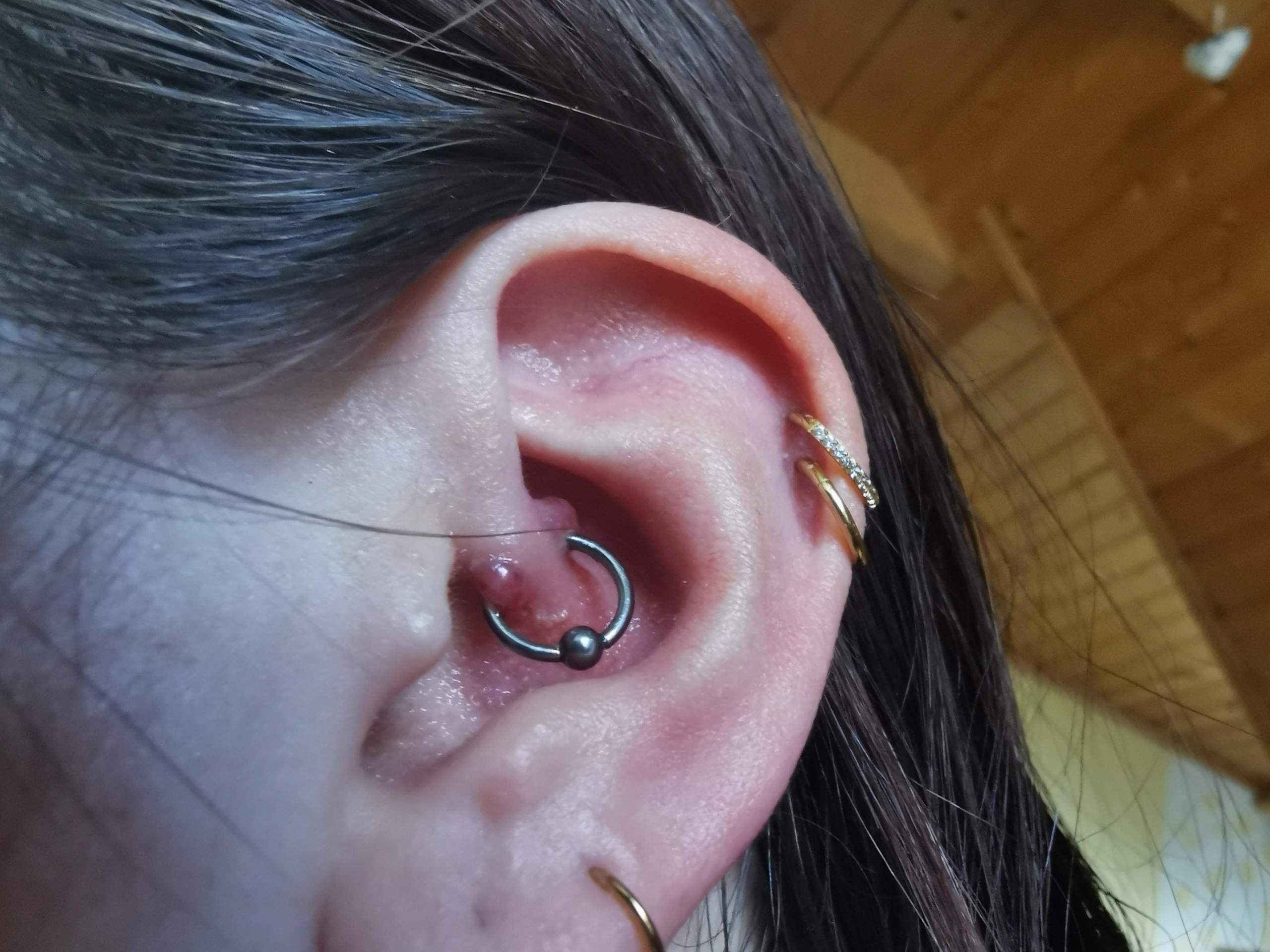 Daith Piercing entzündet, rote große Knubbel an Einstichstellen. Was tun? (Entzündung, Ohr