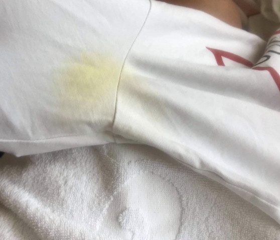 - (Gesundheit und Medizin, Körper, Flecken)