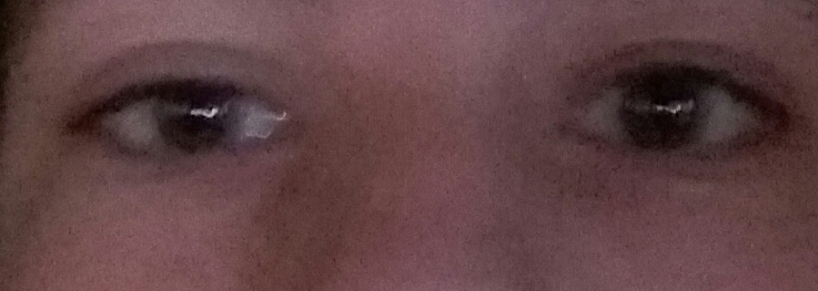 Wie Bekommt Man Ein Blaues Auge Weg