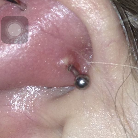 Der Piercing Pocht Was Soll Ich Tun Entzundung