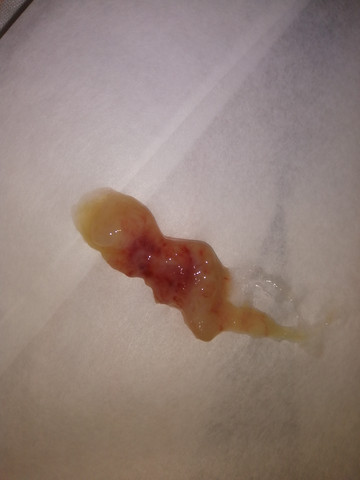 Das Kahm Aus Meinem Hals Normal Gesundheit Und Medizin Arzt Krankheit Das Kahm Aus Meinem Hals Normal Gesundheit Und Medizin Arzt Krankheit