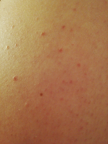Dauerhaft kleine Pickel am Oberschenkel was kann ich tun? (keine rasurpickel)? (Unreinheiten) pickel auf dem oberschenkel