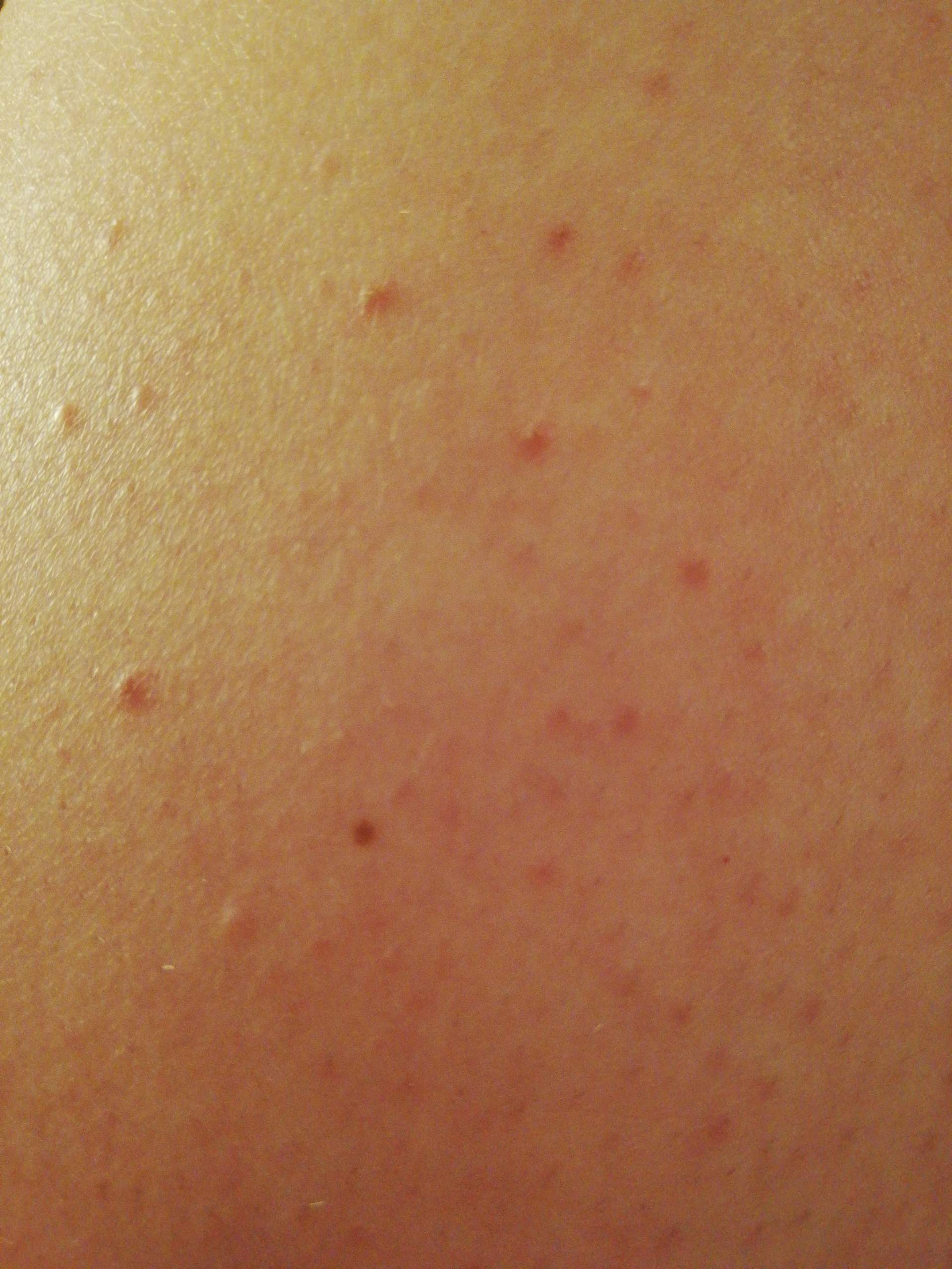 Dauerhaft kleine Pickel am Oberschenkel was kann ich tun? (keine rasurpickel)? (Unreinheiten) pickel an oberschenkel