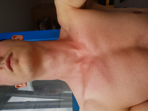 Dauerhafte Rotung Am Hals Obere Brust Gesundheit Und Medizin Sonnenbrand Dauerhafte Rotung Am Hals Obere Brust Gesundheit Und Medizin Sonnenbrand