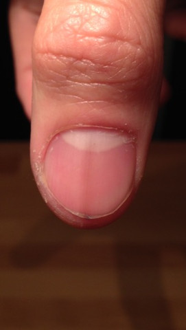Daumen Fingernagel braun / hellbraun? (Gesundheit, Menschen, Körper)