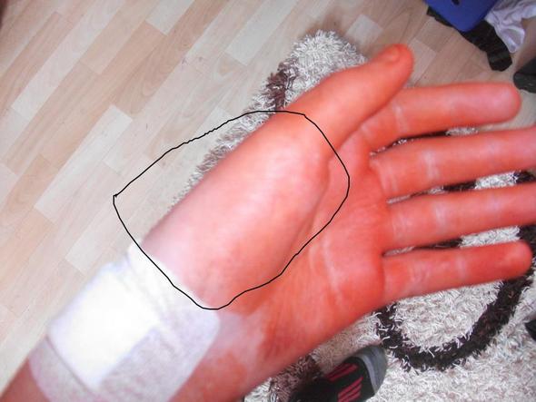 Daumen Fuhlt Sich Nach Op Taub An Siehe Foto Fehler Krankenhaus Operation Daumen Fuhlt Sich Nach Op Taub An Siehe Foto Fehler Krankenhaus Operation