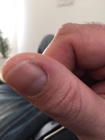 Daumen Nagelhaut Reisst Ein Beauty Nagel Fingernagel