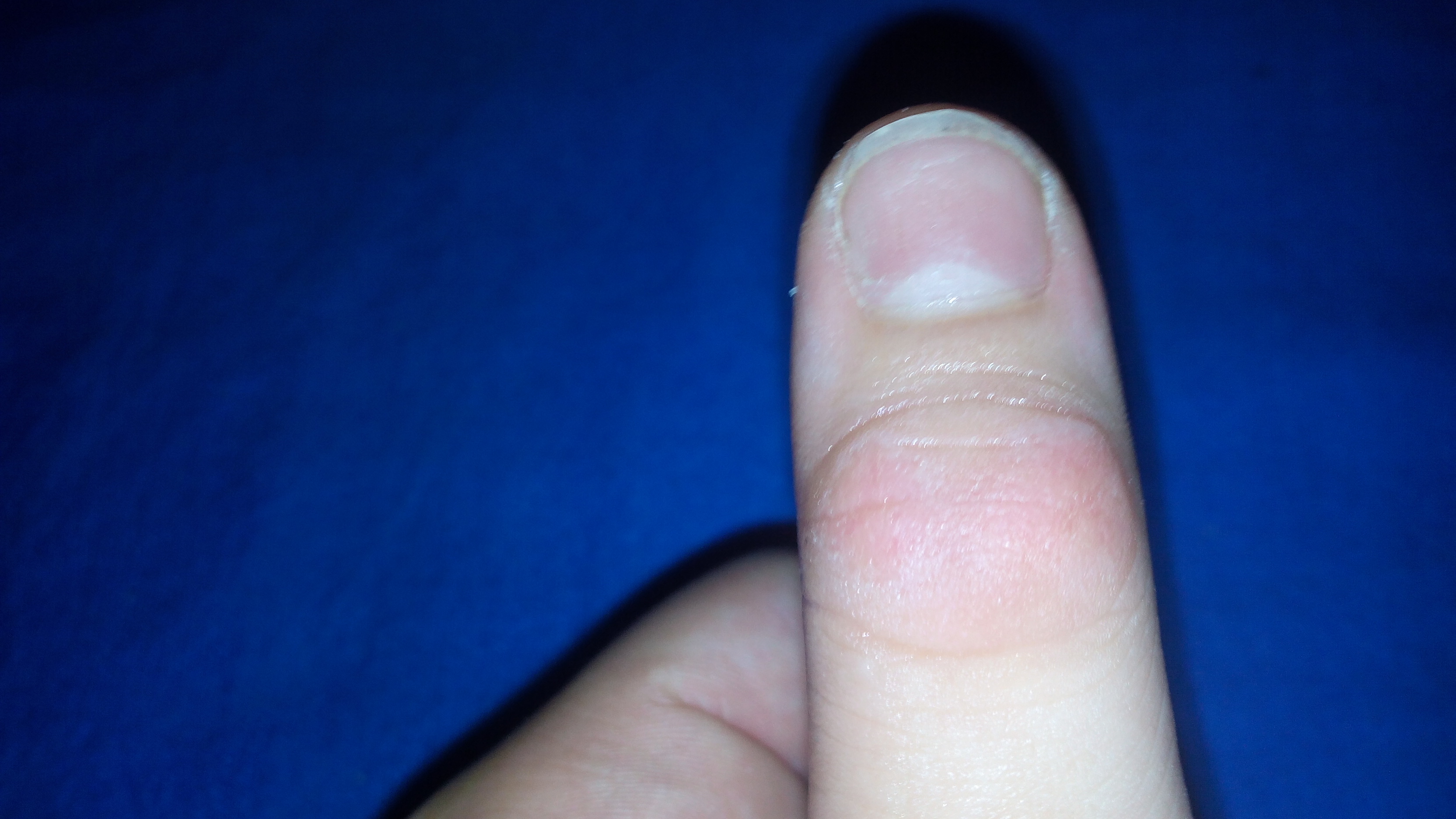 !Daumen Oberseite Angeschwollen HILFE! (Arzt, Finger)