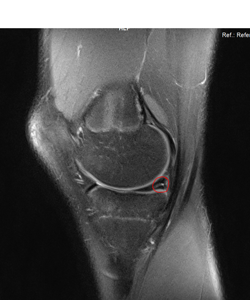 Dehnen Trotz Meniskusriss Gefahrlich Gesundheit Und Medizin Gesundheit Sport Dehnen Trotz Meniskusriss Gefahrlich Gesundheit Und Medizin Gesundheit Sport