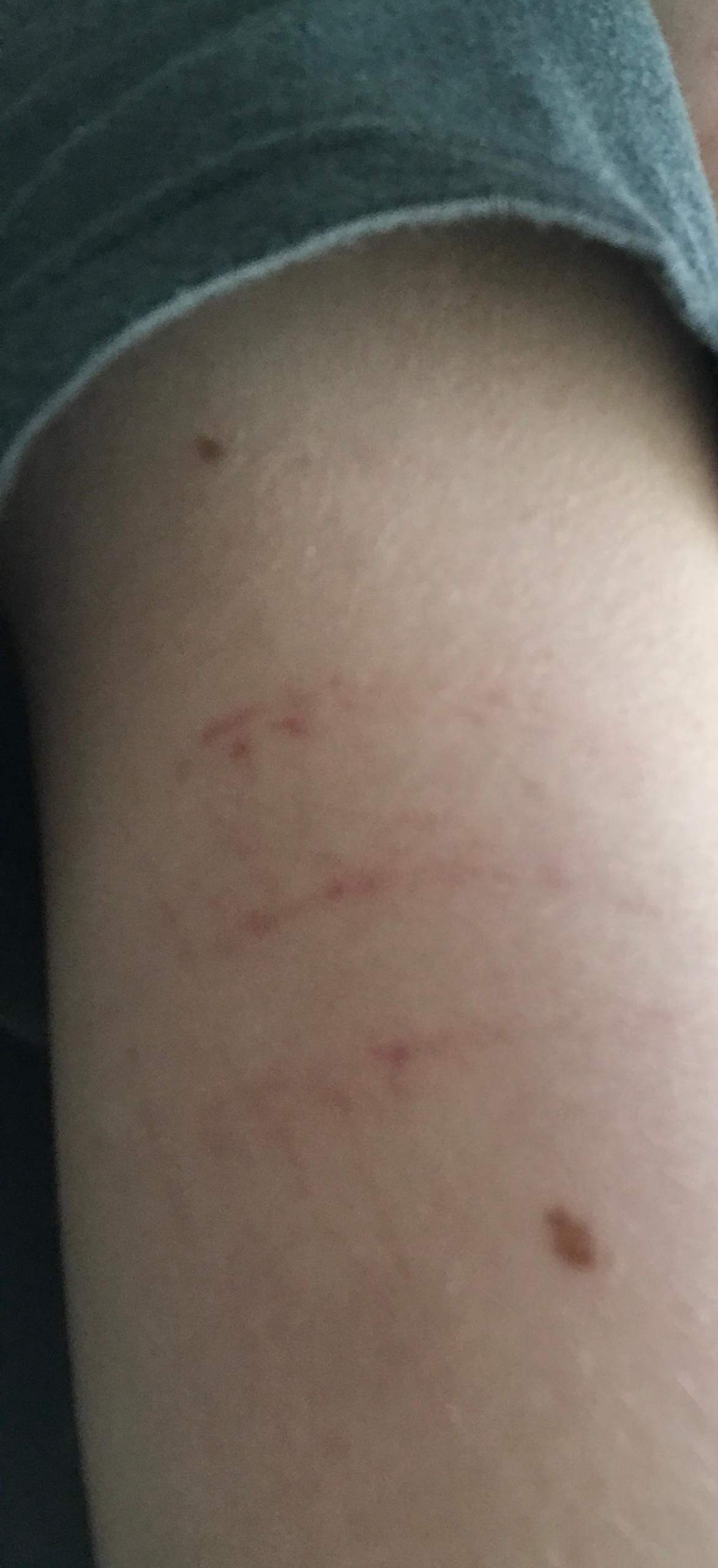 Dehnungsstreifen? (Fitness, Haut, Muskeln)