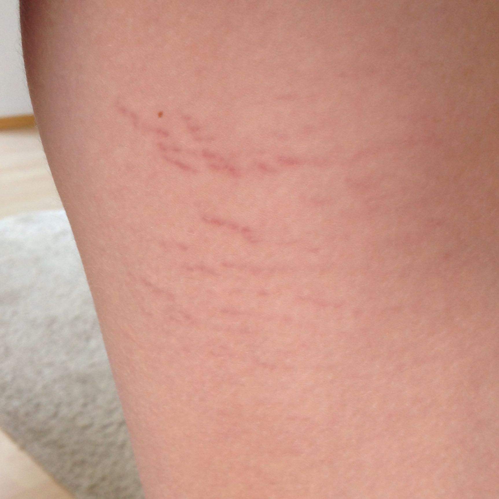 Dehnungsstreifen am Po und oberschenkel? Mit 14? (Haut, Pubertät ...