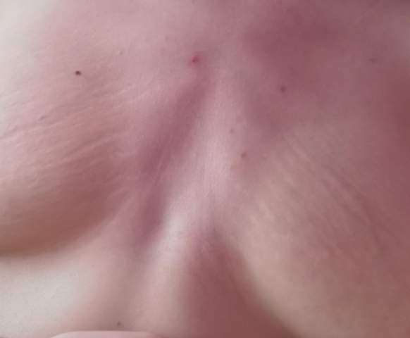 Dehnungsstreifen Auf Der Brust Dehnungsstreifen Auf Der Brust