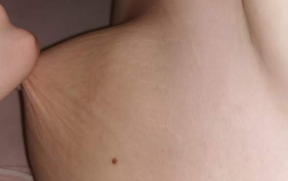 Dehnungsstreifen Auf Der Brust Dehnungsstreifen Auf Der Brust