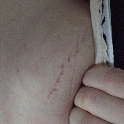 Dehnungsstreifennn Brust Dehnungsstreifen Bluterguss Dehnungsstreifennn Brust Dehnungsstreifen Bluterguss