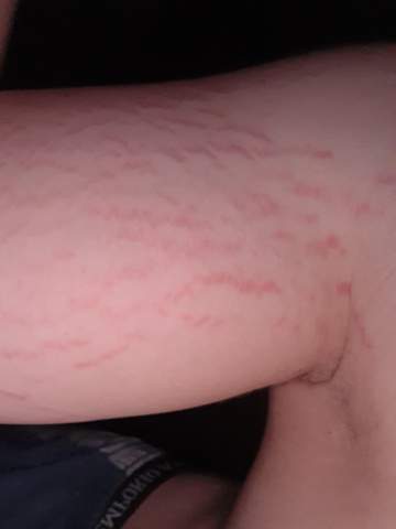 Dehnungsteifen Weg Bekomme N Fitness Dehnungsstreifen