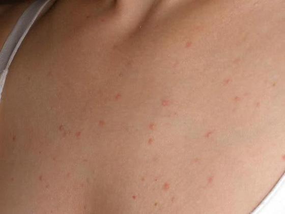 Dekollete- Pflege! (Haut, Pickel, Pubertaet) pickel auf dem rücken frau