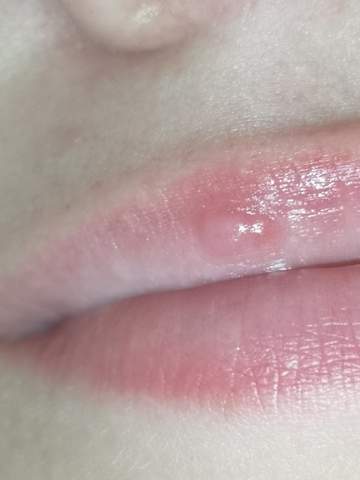 delle an lippe? (Gesundheit und Medizin)