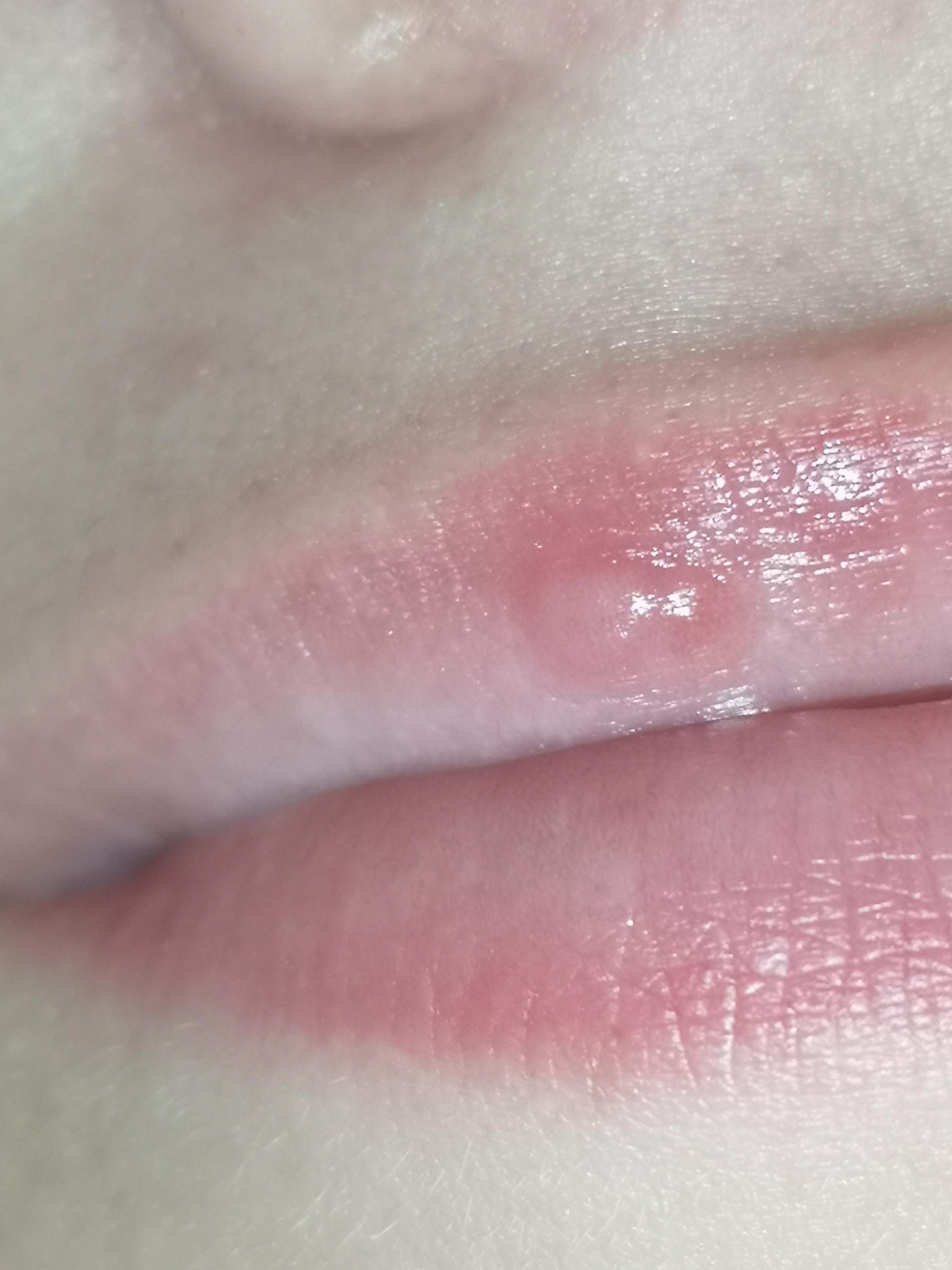 Komische Blase An Der Lippe Innen Delle an der Lippe? (Gesundheit und Medizin)