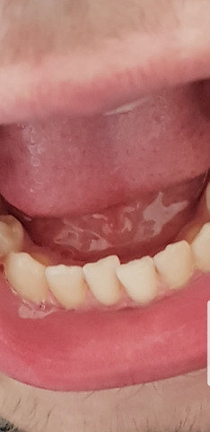 Denkt Ihr Braucht Man Dafur Eine Feste Zahnspange Gesundheit Leben Angst Denkt Ihr Braucht Man Dafur Eine Feste Zahnspange Gesundheit Leben Angst