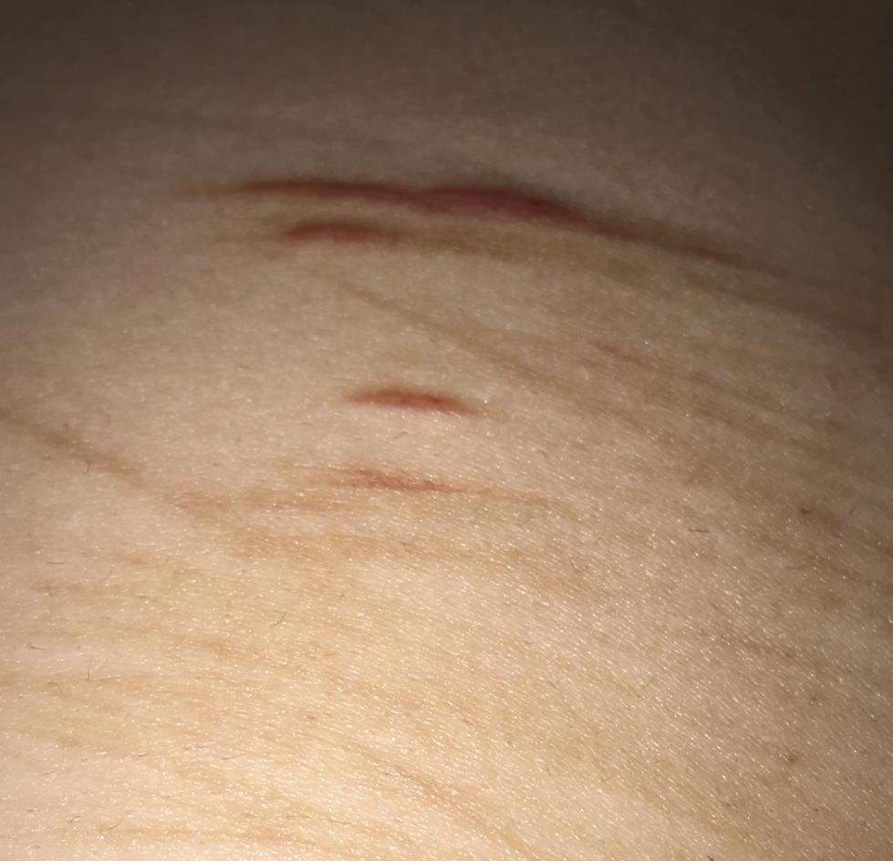 Denkt ihr da würden Leute dumme Sprüche im Schwimmbad machen? (Körper, Meinung, Narben) Denkt ihr da würden Leute dumme Sprüche im Schwimmbad machen? (Körper, Meinung, Narben)