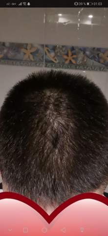 Dünne haare kopfhaut sichtbar
