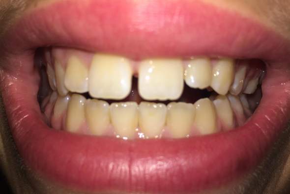 Denkt Ihr Ich Brauche Eine Zahnspange Zahne Zahnlucke Schrag