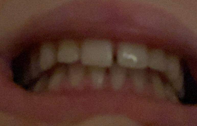 Ich Will Eine Zahnspange Brauche Aber Keine Denkt ihr ich brauche eine zahnspange? (Gesundheit und Medizin, Zähne