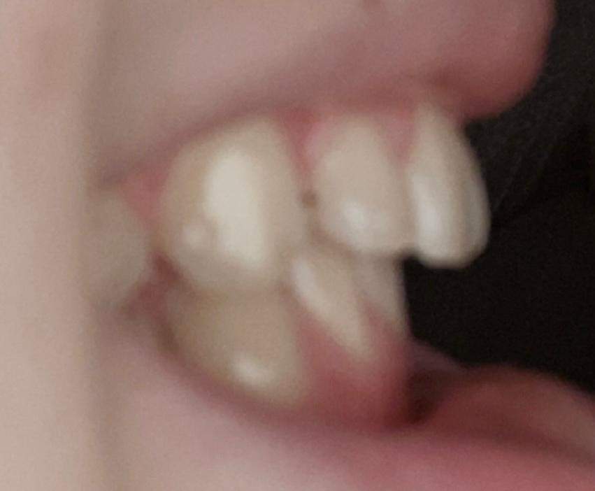 Ich Will Eine Zahnspange Brauche Aber Keine Denkt ihr ich brauche eine zahnspange? (Gesundheit und Medizin, Zähne