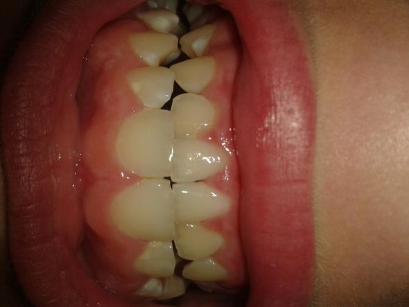 Meine Krummen Zähne - (Zahnspange, krumme Zähne)
