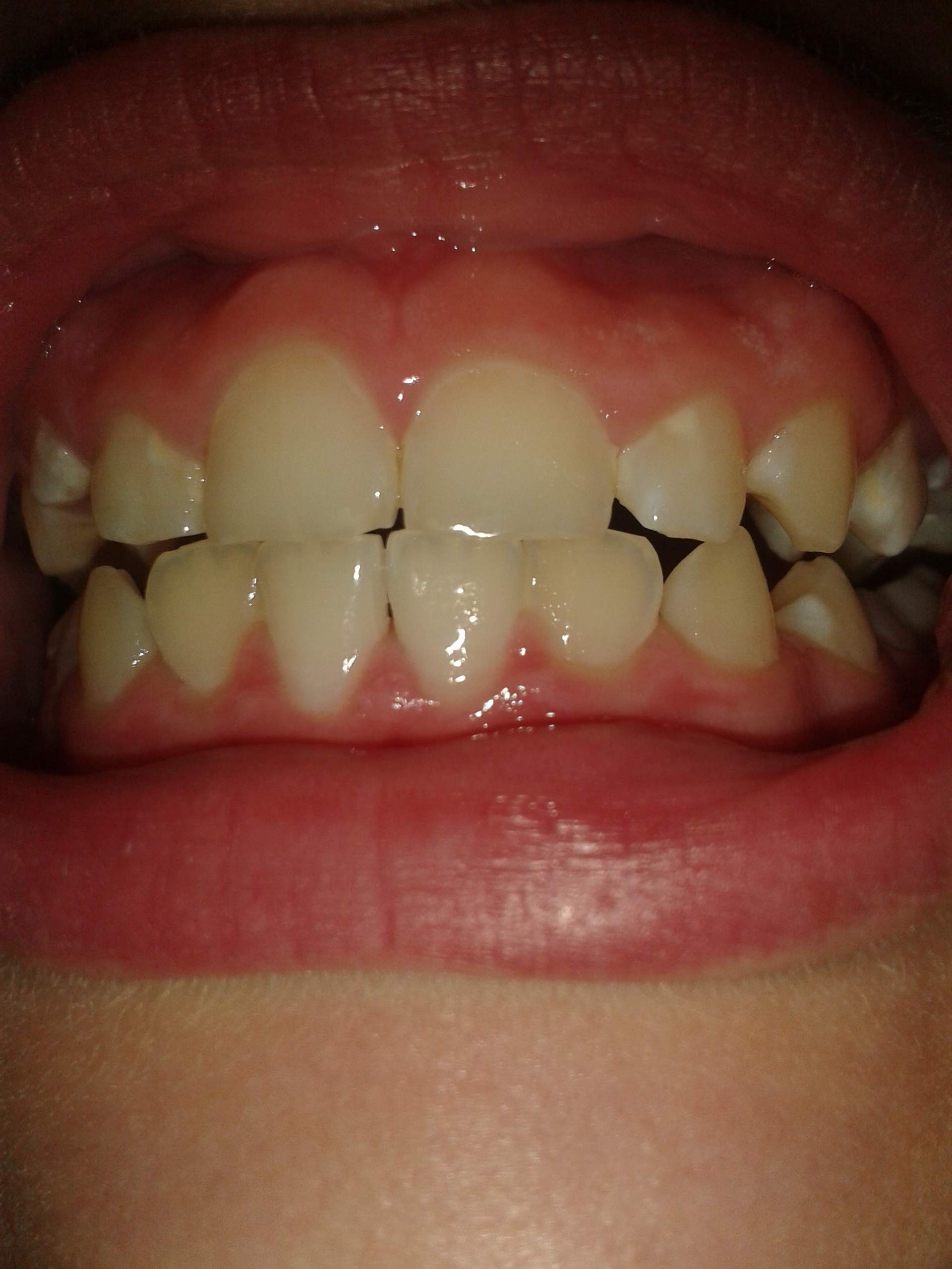 Ich Will Eine Zahnspange Brauche Aber Keine Denkt ihr ich brauche eine Zahnspange denn ich hasse irgendwie meine