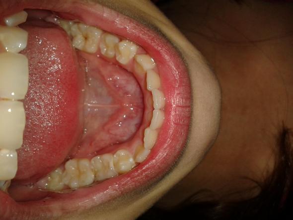 Meine Zwei krumme Zähne - (Zahnspange, krumme Zähne)
