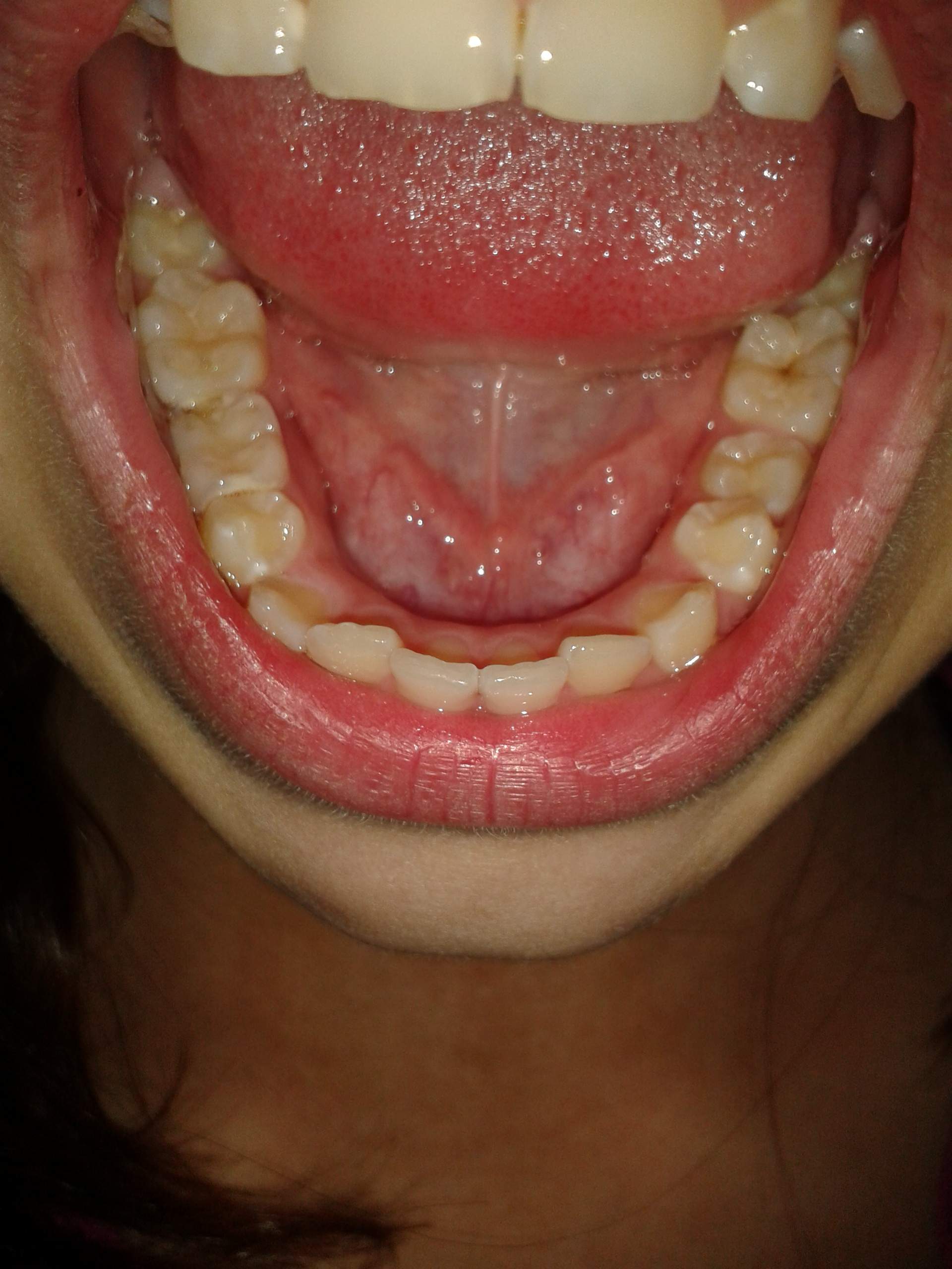 Ich Will Eine Zahnspange Brauche Aber Keine Denkt ihr ich brauche eine Zahnspange denn ich hasse irgendwie meine