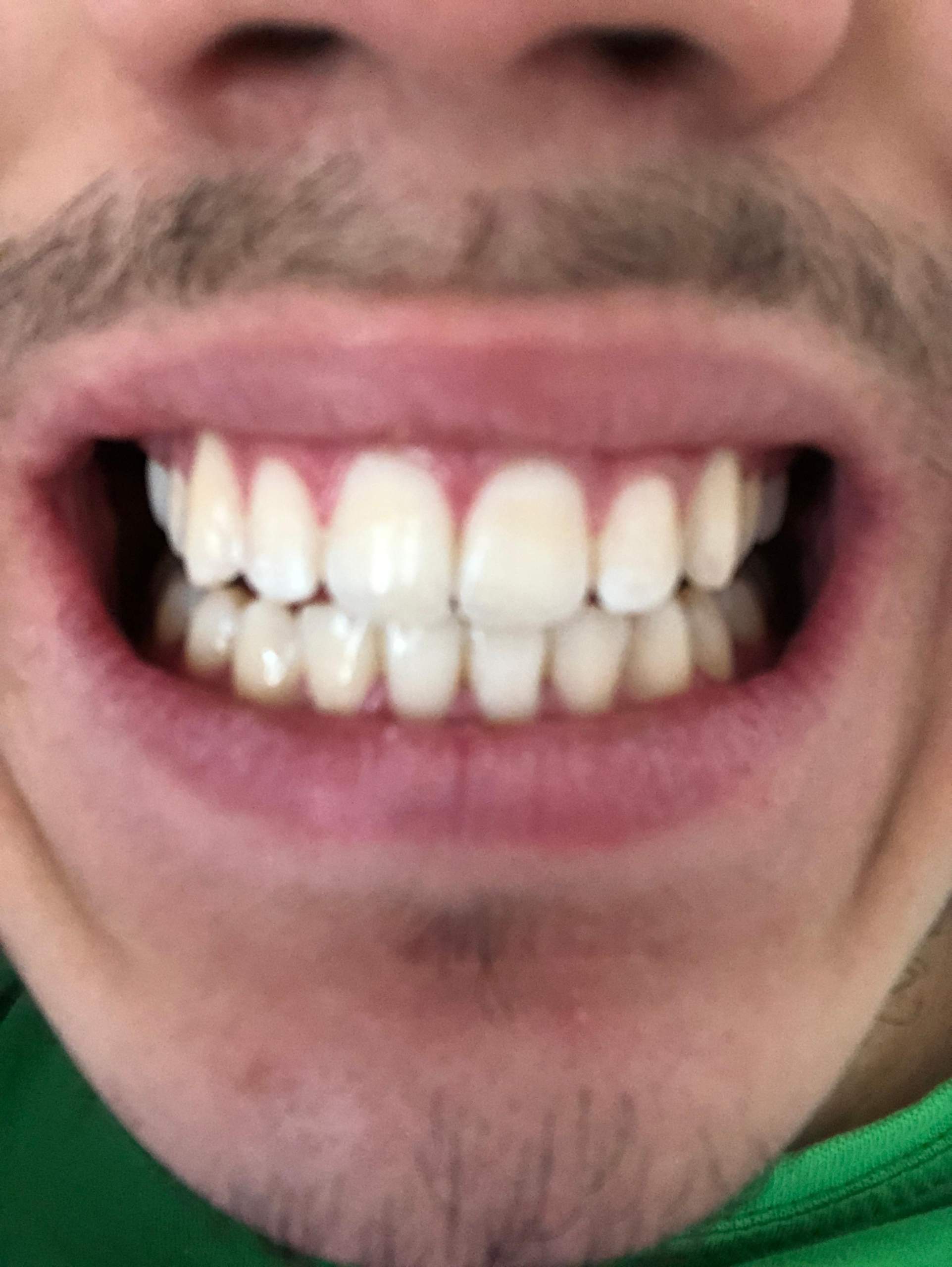 Ich Will Eine Zahnspange Brauche Aber Keine Denkt Ihr ich brauche eine Zahnspange (mit bilder) (bin 16)? (Zähne)