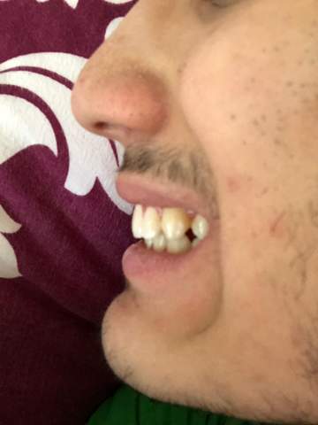 Denkt Ihr Ich Brauche Eine Zahnspange Mit Bilder Bin 16 Zahne Denkt Ihr Ich Brauche Eine Zahnspange Mit Bilder Bin 16 Zahne