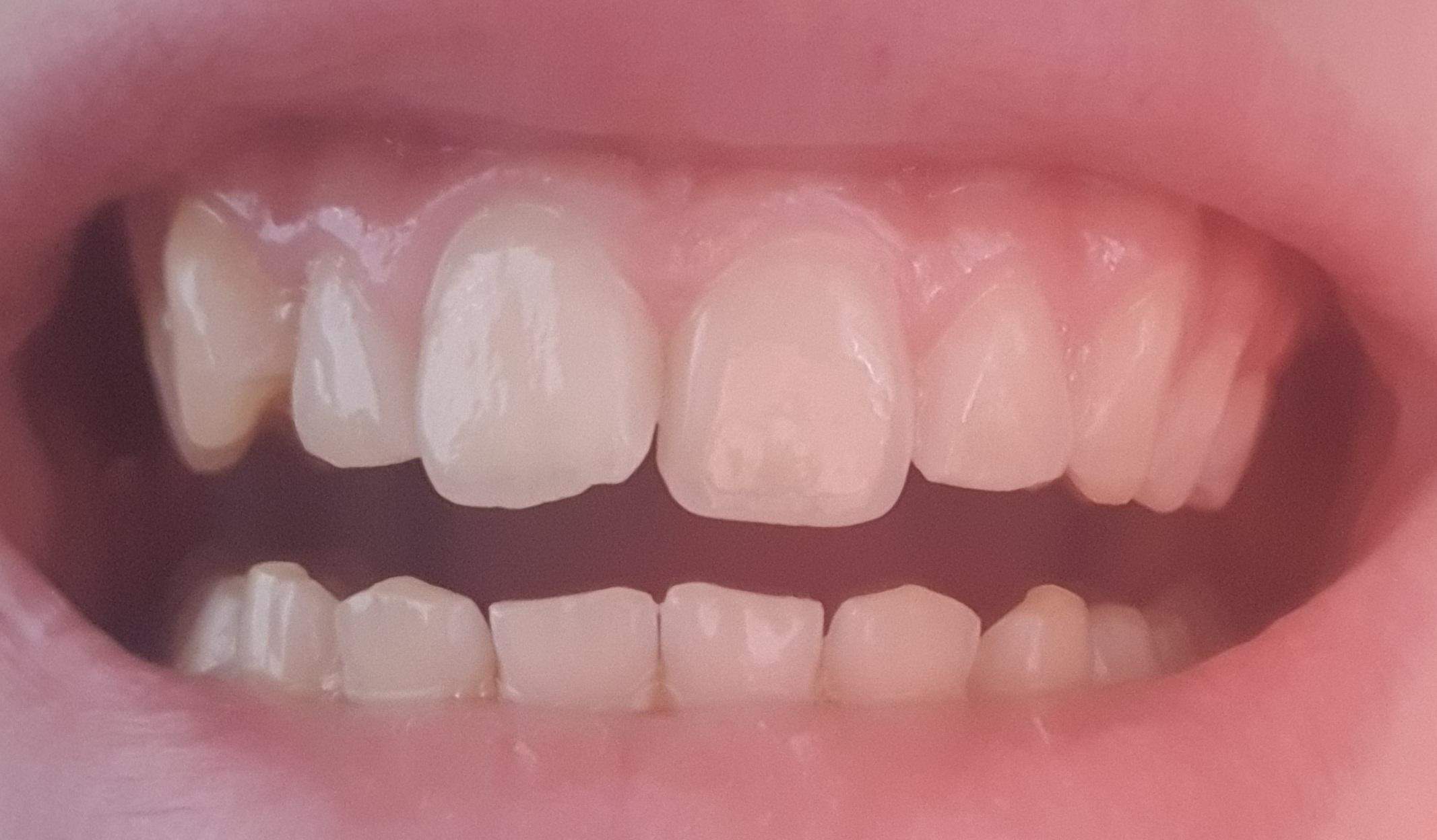 Ich Will Eine Zahnspange Brauche Aber Keine Denkt ihr ich brauche wieder eine Zahnspange? (Gesundheit und Medizin