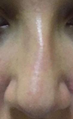 Denkt Ihr Meine Nase Ist Gebrochen Gesundheit Und Medizin Beauty Denkt Ihr Meine Nase Ist Gebrochen Gesundheit Und Medizin Beauty