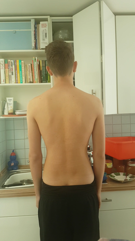Denkt Ihr Meine Skoliose Ist Schlimmer Geworden Bilder Sport Medizin Arzt Denkt Ihr Meine Skoliose Ist Schlimmer Geworden Bilder Sport Medizin Arzt