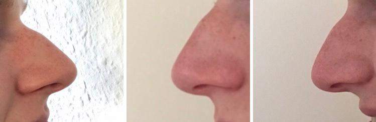 Der Bruder meines Freundes sagt er hat eine Hakennase oder eine ...